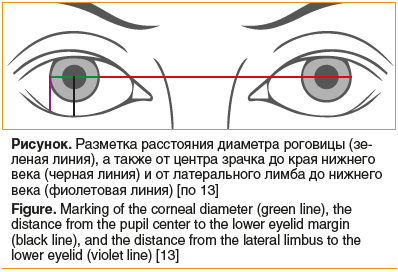 Рисунок. Разметка расстояния диаметра роговицы (зеленая линия), а также от центра зрачка до края нижнего века (черная линия) и от латерального лимба до нижнего века (фиолетовая линия) [по 13] Figure. Marking of the corneal diameter (green line), the dista