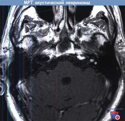 МРТ акустической невриномы
