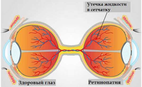 Классификация диабетической ретинопатии (стадии)