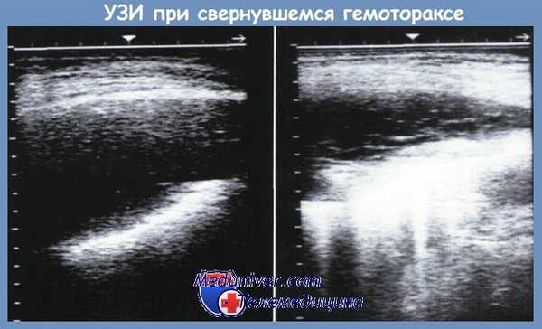 УЗИ при свернувшемся гемотораксе