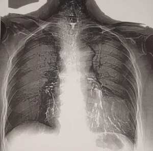 Остатки бария сульфата в бронхах у пациентки с пищеводно-бронхиальными свищами