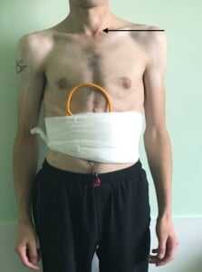 Удаление свища пищевода