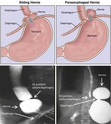 Рентген пищевода и желудка с контрастированием
