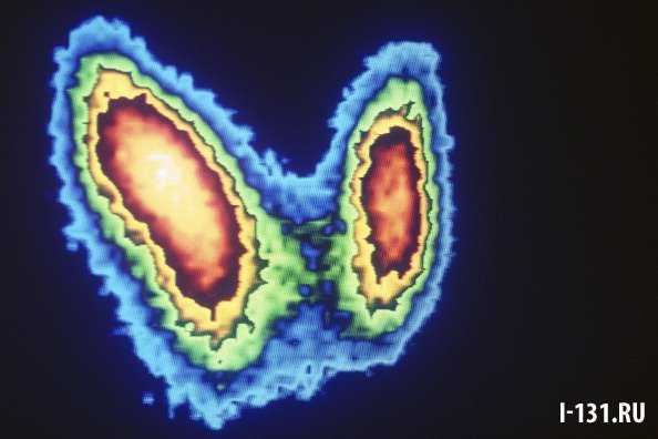Папиллярный рак щитовидной железы