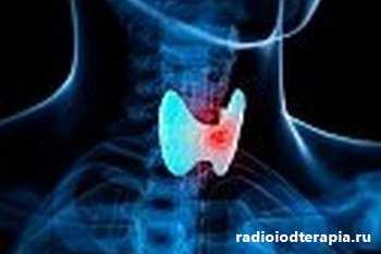 Радиойодтерапия: лечение щитовидки