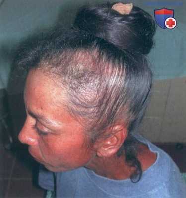 Тракционная потеря волос и трихотилломания