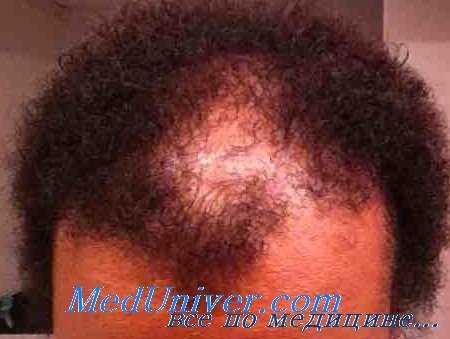 трихотилломания