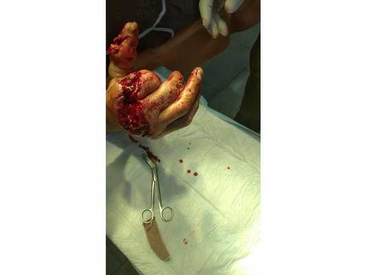 Рваные раны у основания пальцев