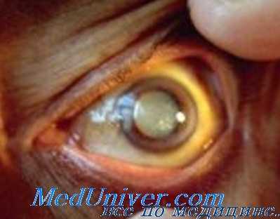 тринитротолуоловая катаракта