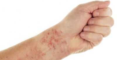 геморрагия при тромбоцитопении