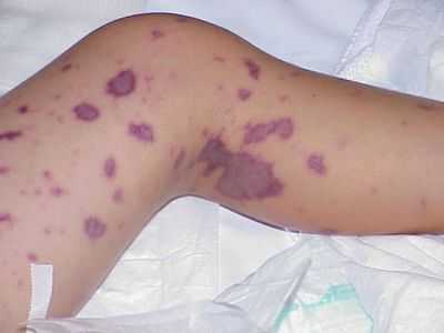 Тромбоцитопения