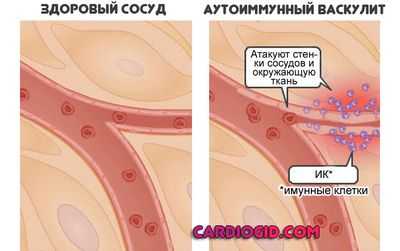 аутоммунный-васкулит