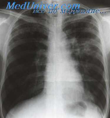 сухой плеврит при туберкулезе