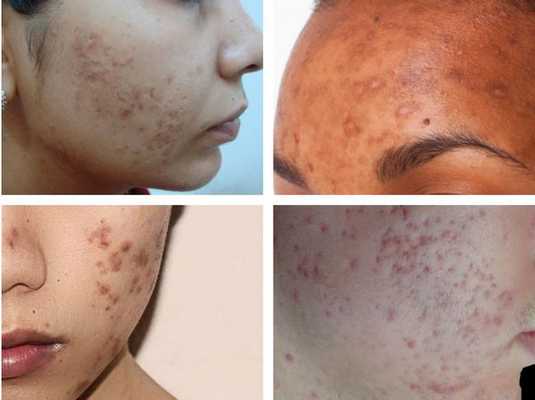 Гиперпигментация