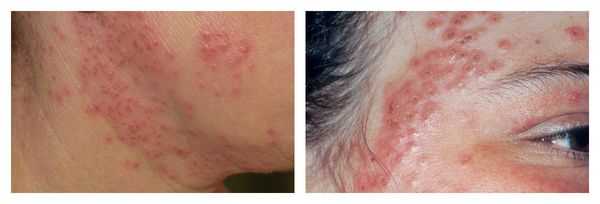 Герпетическая экзема