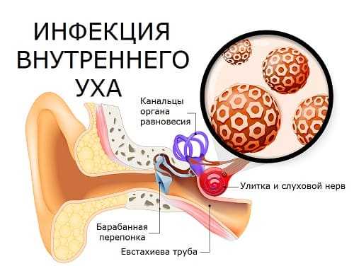Инфекции внутреннего уха причина кохлеарного неврита