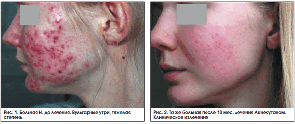 Рис. 1. Больная Н. до лечения. Вульгарные угри, тяжелая степень