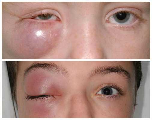 Пресептальный целлюлит