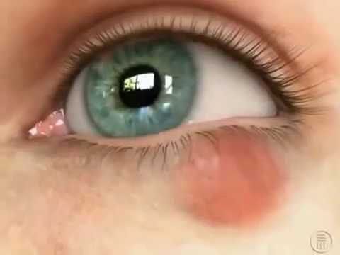 Видео Халязион и его лечение