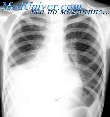 хроническая эмпиема плевры