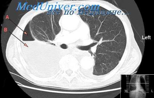 хроническая эмпиема плевры