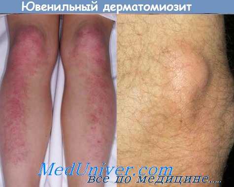 ювенильный дерматомиозит