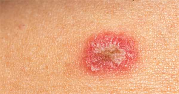 Грибок кожи