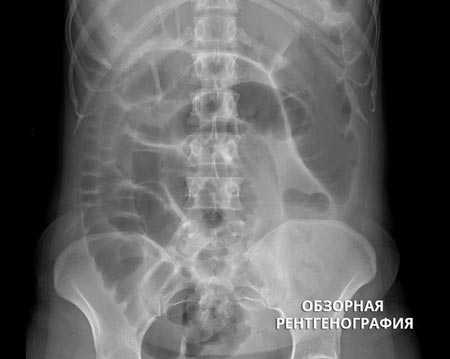 Кишечная непроходимость: обзорная рентгенография
