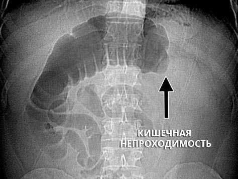 Кишечная непроходимость