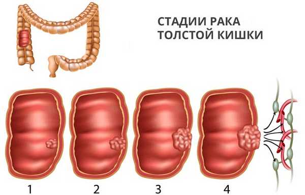 Стадии рака толстой кишки