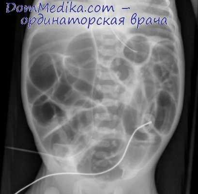 кишечная непроходимость на рентгене