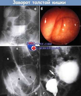 Заворот толстой кишки