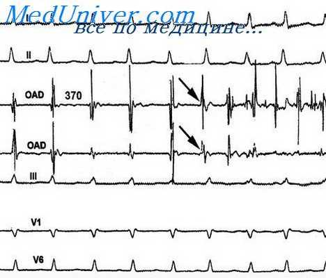 желудочковые аритмии
