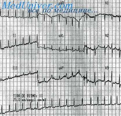 желудочковые аритмии