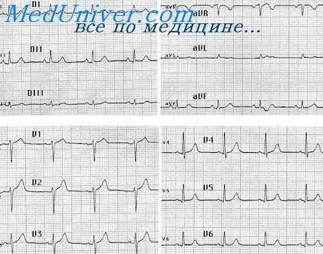 желудочковые эктопии