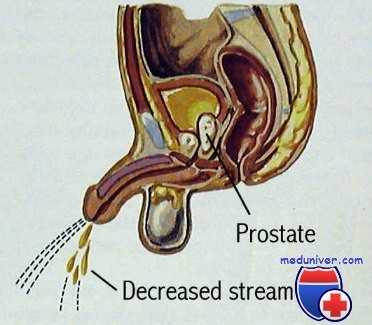 таблетки при аденоме простаты