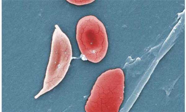 Дрепаноциты