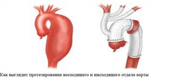 Как выглядит протезирование восходящего и нисходящего отдела аорты