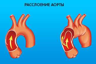 Типичные и нетипичные клинические проявления аневризмы аорты