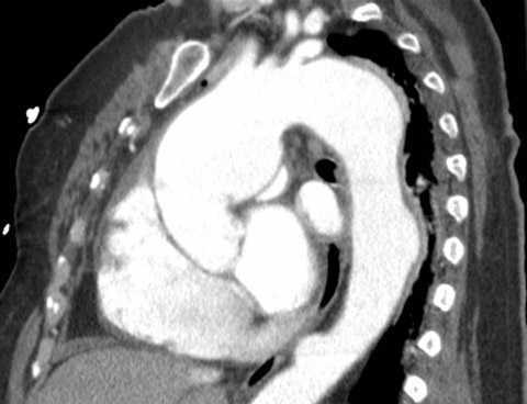 сифилитическое поражение аорты