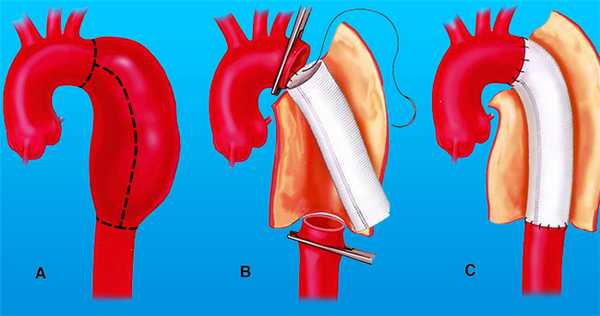 Методы лечения аневризмы аорты