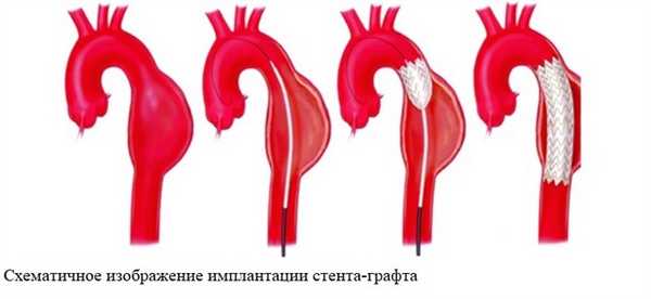 Схематичное изображение имплантации стента-графта