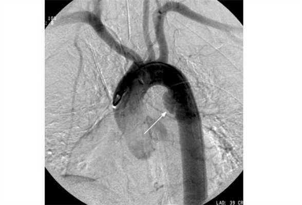 Пример аортографии. Стрелкой указано мешковидное выпячивание (аневризма)