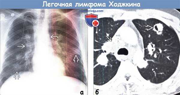 Легочная лимфома Ходжкина на рентгенограмме, КТ