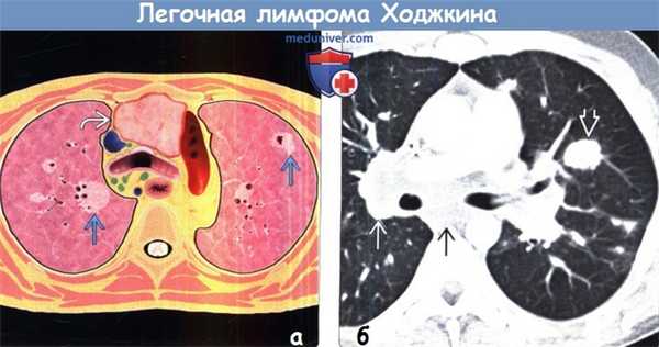 Легочная лимфома Ходжкина на КТ
