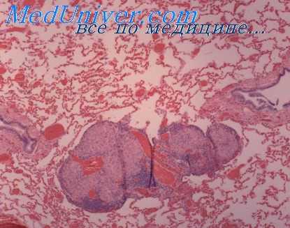 кровоток в легких