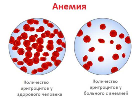 Анемия.jpg