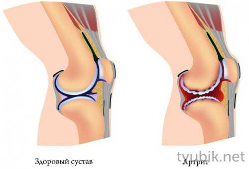 Ревматоидный артрит колена