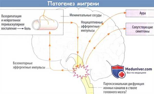 Патогенез (механизмы развития) мигрени