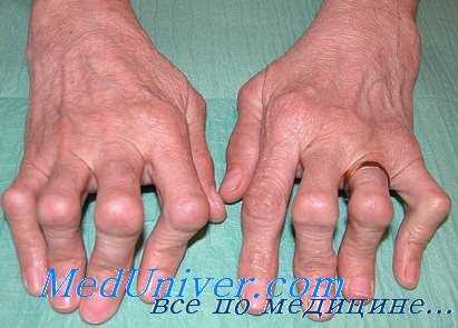 ревматоидный артрит